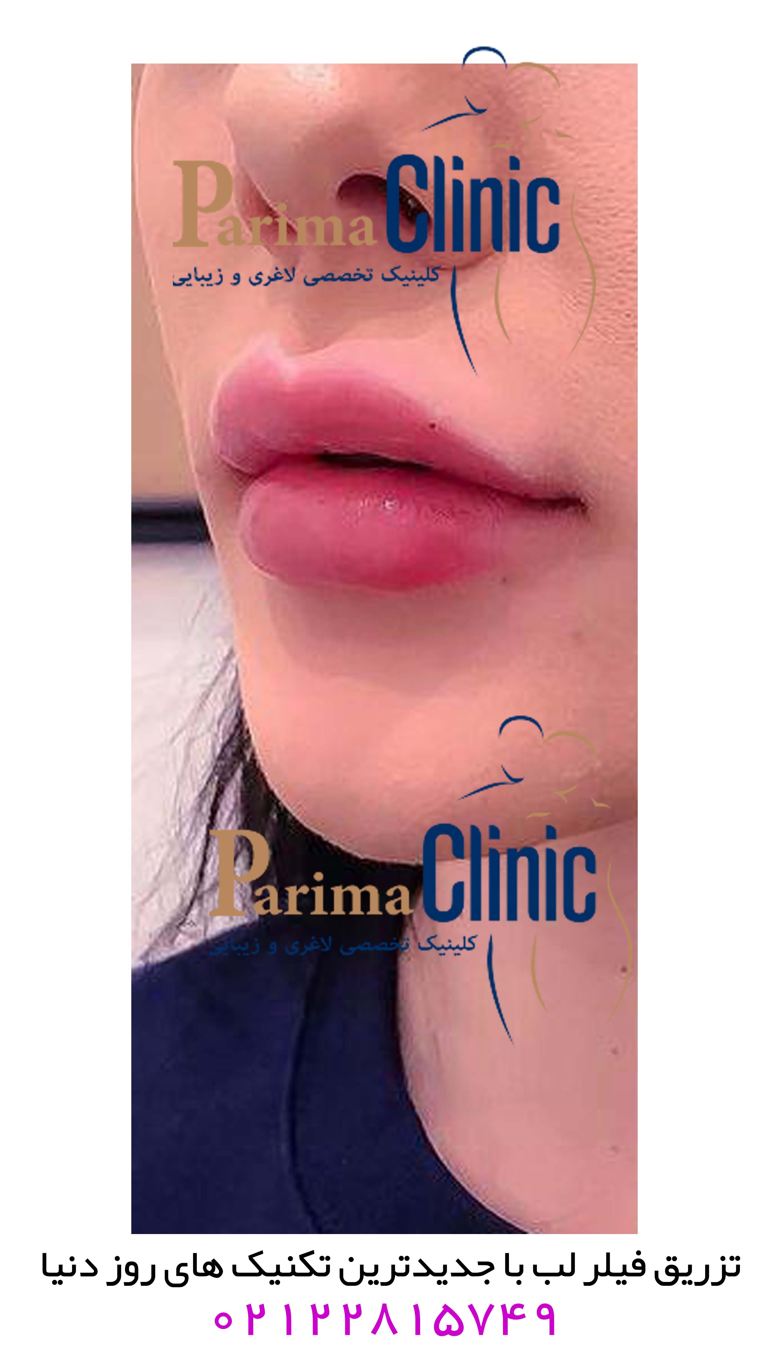 هزینه تزریق ژل لب + عکس قبل و بعد ژل لب 2 تزریق ژل لب